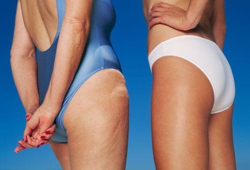 Top Tips And Techniques To Get Rid Of Cellulite